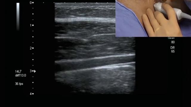 Transverse Abdominis Plane Block (ultrasound guided) смотреть онлайн