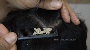 Царапины от перхоти большими хлопьями #872