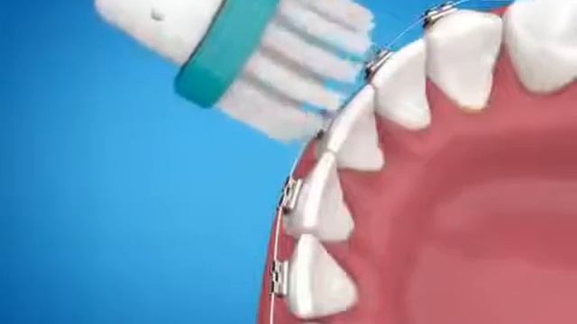 Oral B Ortho potkefe hatékonyan tisztitja a fogszabályozó készüléket смотреть онлайн