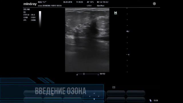 озонотерапия в маммологии смотреть онлайн