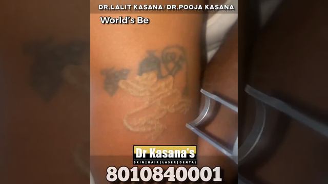 World’s best laser for Tattoo Removal Treatment at Dr Kasana’s Clinic смотреть онлайн