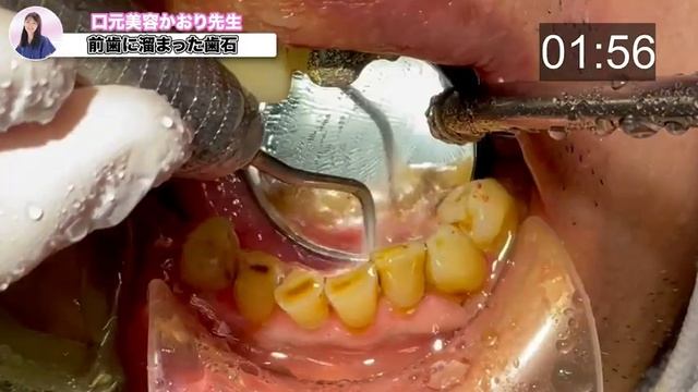 歯石放置したらこうなるで！色素沈着までしてもうて口も臭なるよ〜 смотреть онлайн