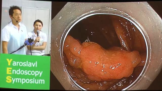 24Live Yutaka Saito LST G ободочной кишки, Эндоскопическое подтверждение инвазивного рака
