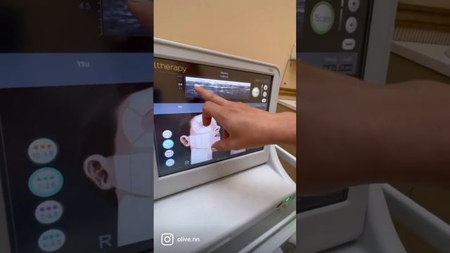 Диагностика перед смас лифтингом в клинике O'LIVE смотреть онлайн