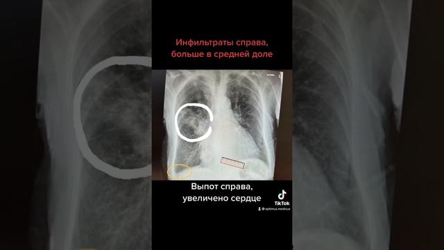 Рентген грудной клетки: Инфильтративные изменения в лёгких справа. Плевральный выпот смотреть онлайн