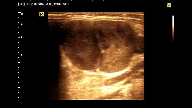 Right sided Submandibular and posterior auricular lymphadenopathy || Neck lymph node смотреть онлайн