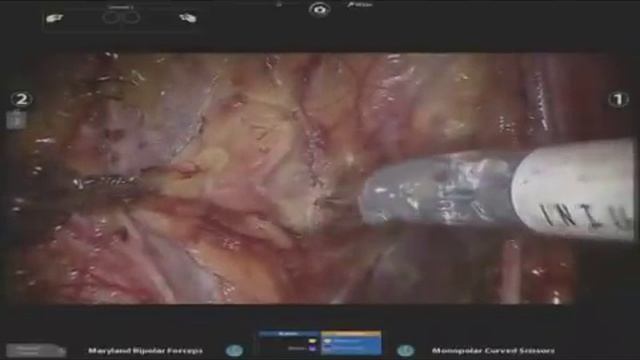 Robotic Extended Pelvic Lymph Node Dissection смотреть онлайн