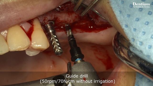 Sinus lifting using Osteotome on post maxilla смотреть онлайн