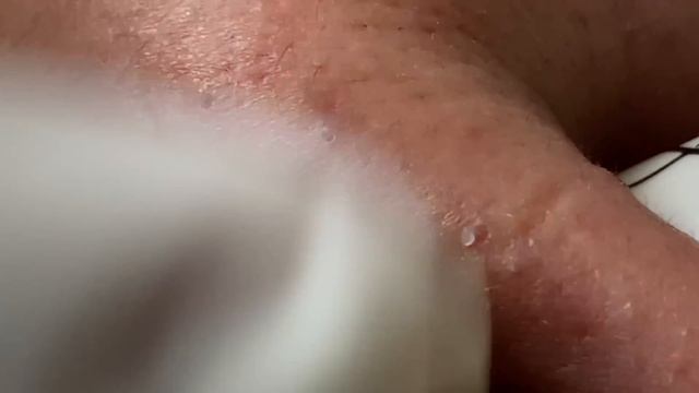 Acne Treatment Huong Da Nang#573 | 2023 смотреть онлайн