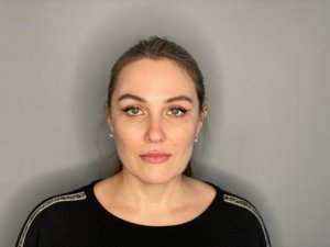 Блефаропластика. Результат спустя 2 недели