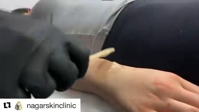 Laser hair removal with the soprano ice laser machine смотреть онлайн