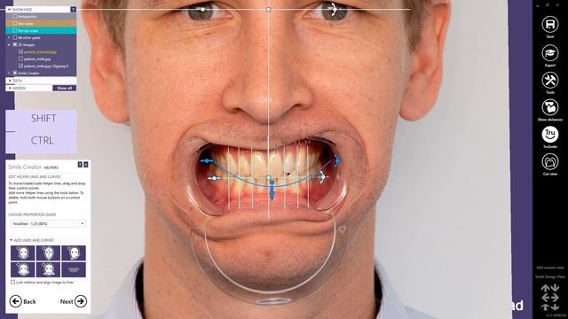 exocad Quick Guide: Get the most out of your Smile Creator Module! смотреть онлайн