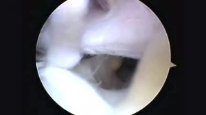 Диагностическая артроскопия коленного сустава