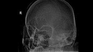 Укладка для рентгенографии орбиты