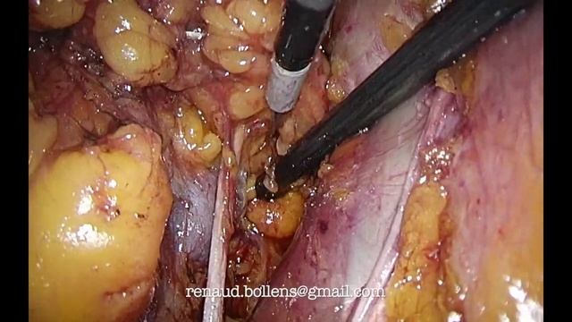right pelvic lymph node dissection смотреть онлайн