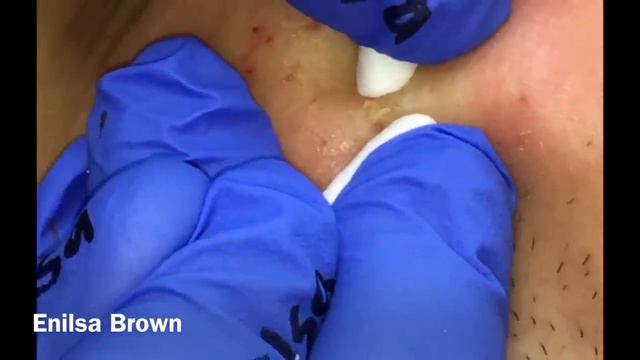 Christian's Acne Treatment ( Blackheads Extractions)