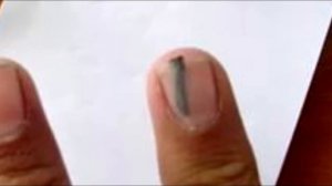 ЧТО БУДЕТ, ЕСЛИ НЕ ВЫТАЩИТЬ ЗАНОЗУ