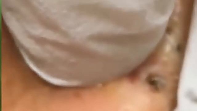 Выдавливание прыщей. смотреть онлайн