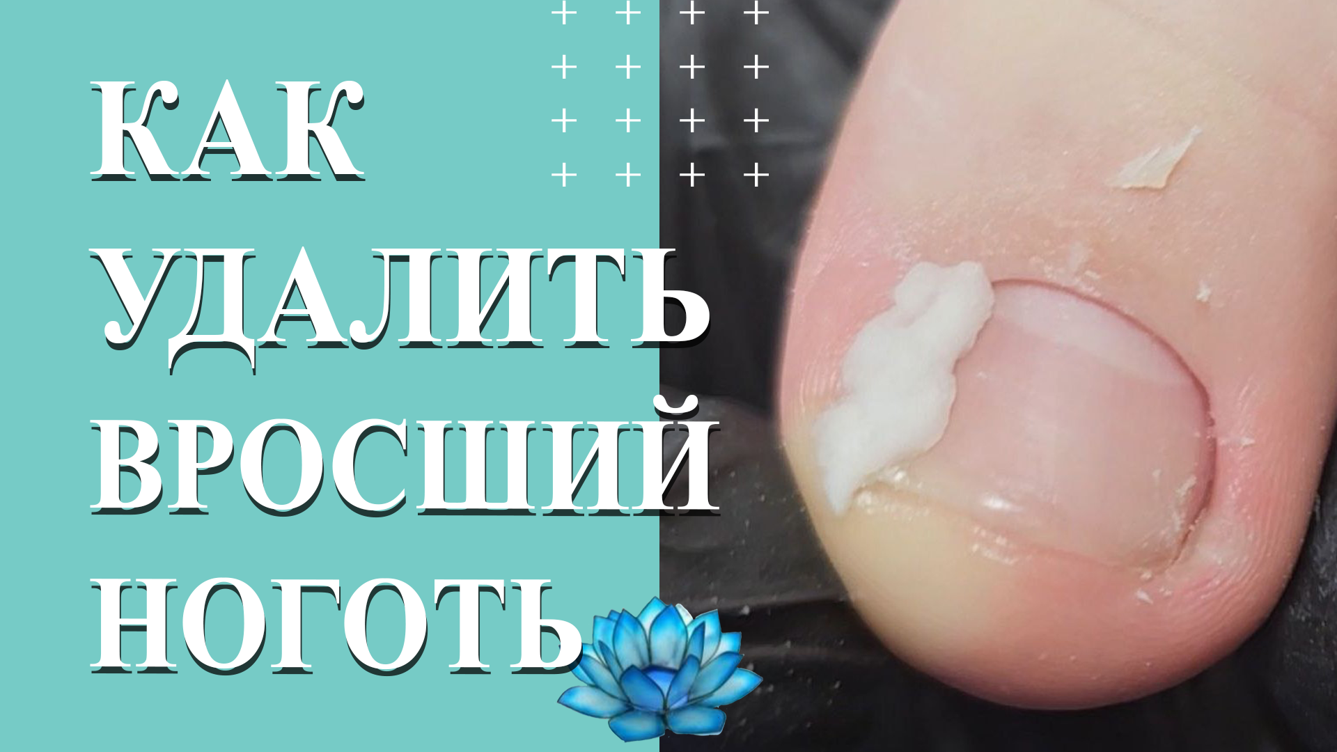 Онихокриптоз. У клиента вросший ноготь на большом пальце ноги. Удаление. смотреть онлайн