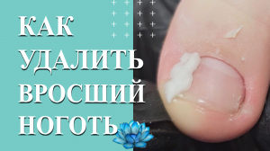 Онихокриптоз. У клиента вросший ноготь на большом пальце ноги. Удаление.