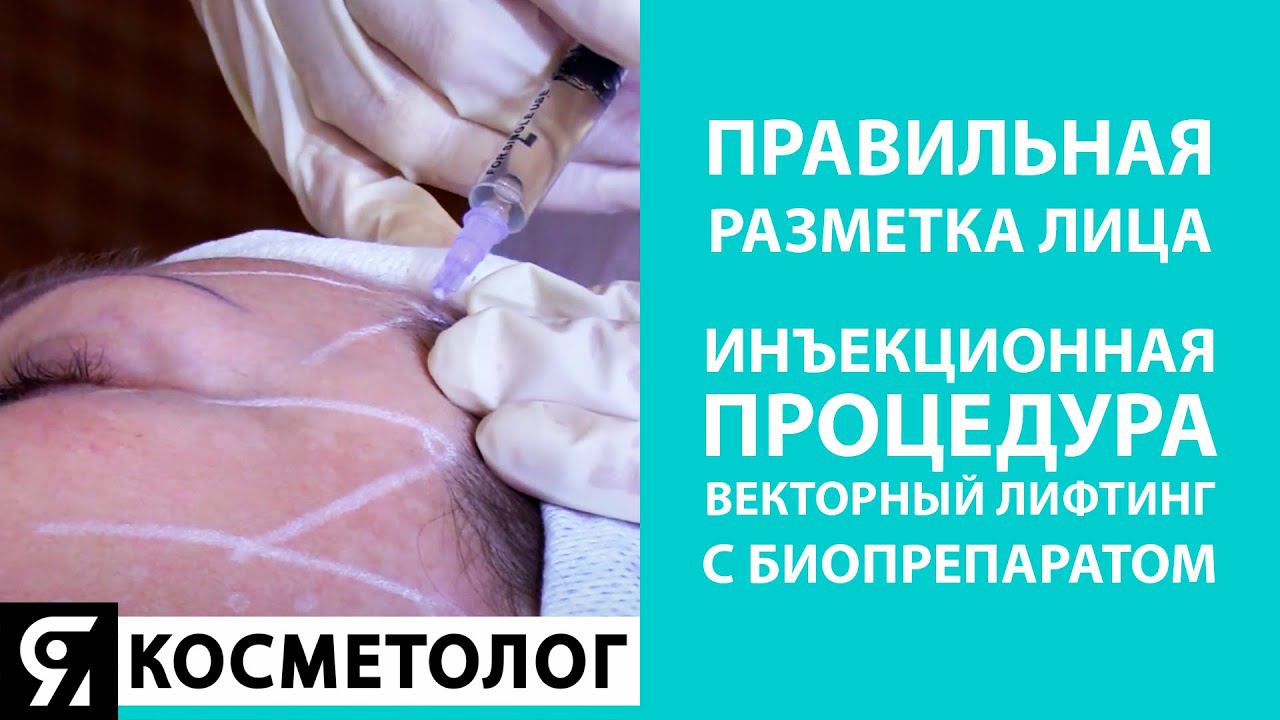 Правильная разметка лица. Инъекционная процедура «Векторный Лифтинг» с биопрепаратом CURACEN смотреть онлайн