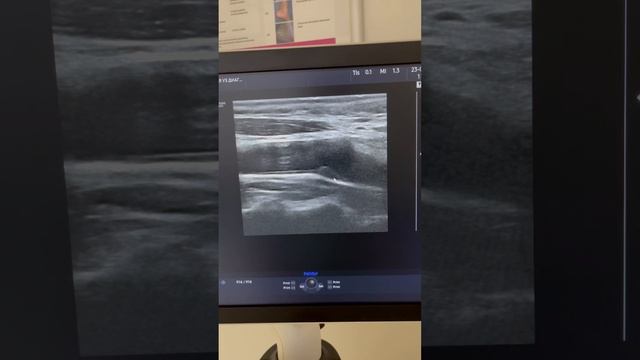 Холестериновая бляшка в артерии. Атеросклероз как лечить. Лечение сосудов. Узи сосудов. Флеболог смотреть онлайн