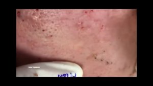 ДАВИМ ЧЕРНЫЕ ТОЧКИ НА ЛИЦЕ / 2018 / ИЗБАВЛЕНИЕ ОТ ПРЫЩЕЙ, УГРЕЙ