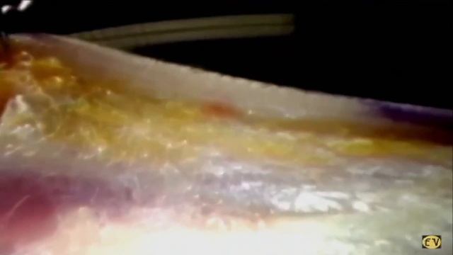 Что такое фасция? Почему это важно?