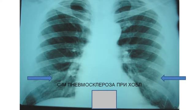 Гноевых Валерий Викторович_Пропедевтика внутренних болезней_Лекция 2 смотреть онлайн