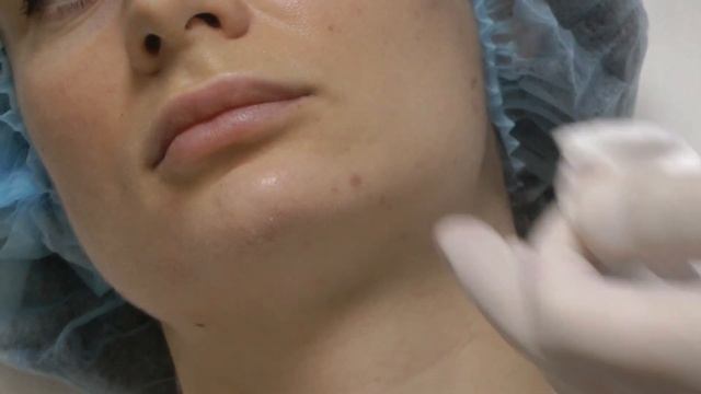 Контурная пластика средней и нижней трети лица. Воркшоп Dr.Valeriy Potiy смотреть онлайн