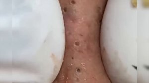 ? ГИГАНТСКИЕ ЧЕРНЫЕ ТОЧКИ/black heads removed
