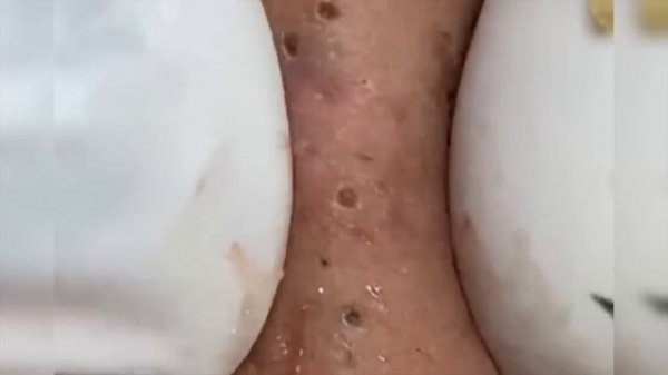 ? ГИГАНТСКИЕ ЧЕРНЫЕ ТОЧКИ/black heads removed