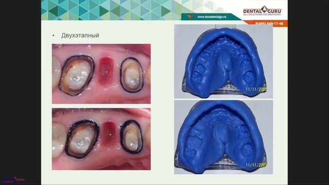 Вебинар: Снятие слепков(оттисков) смотреть онлайн