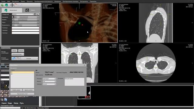 Окно узелков в лёгких в режиме анализа узелковых образований в лёгких по данным КТ смотреть онлайн