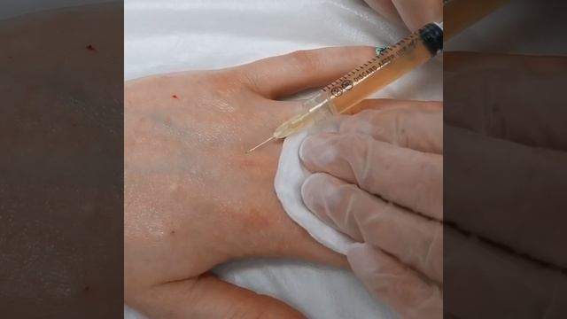 Плазмолифтинг рук смотреть онлайн