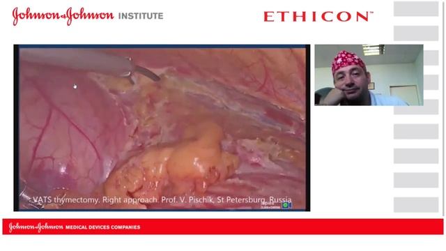 Торакоскопическая тимэктомия.