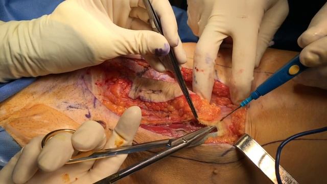 Groin lymph node removal смотреть онлайн