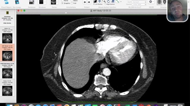 | GIT | Malignancy | always check for PE смотреть онлайн