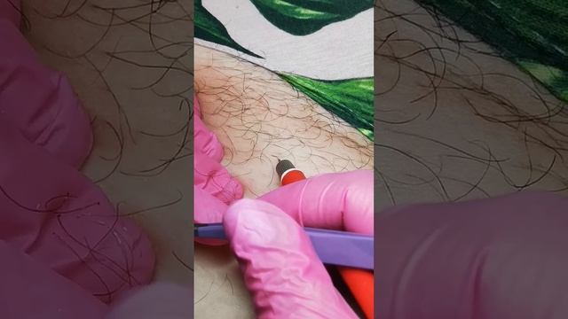 Процесс работы Электроэпиляция. Волос не выдергивается, кожа не прокалывается, ввод точно в фоллику смотреть онлайн