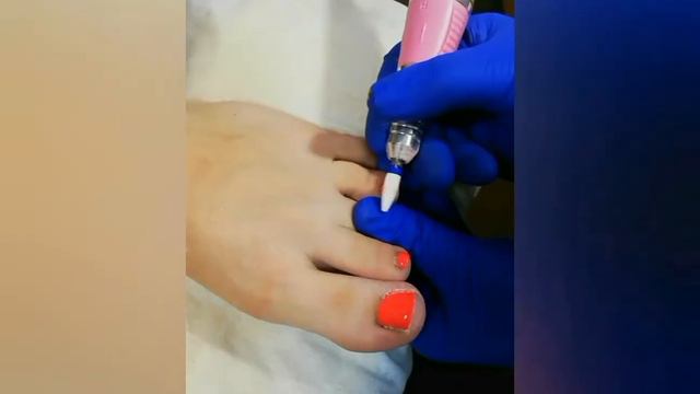 Місяць після видалення піднігтьового мозоля. Результат. смотреть онлайн