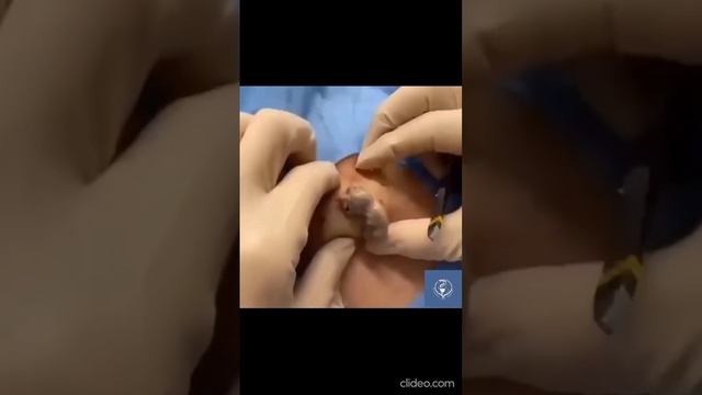 Большой-гнойный жировик🤕 смотреть онлайн