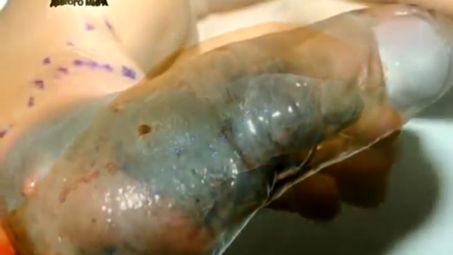 Меня укусили (I Was Bitten) - Укус шпильковой змеи (Atractaspis Engaddensis)