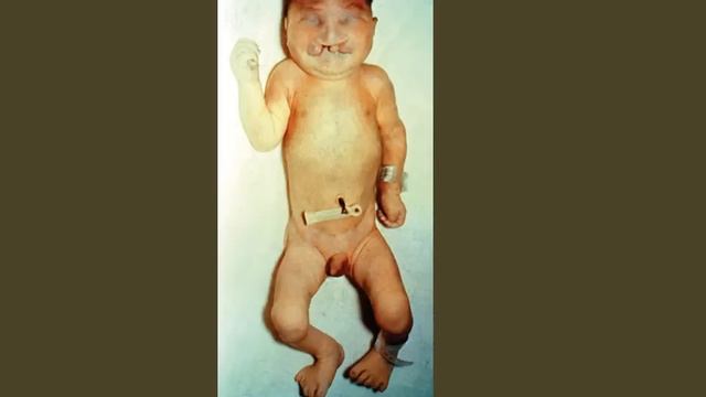 TRISOMY 13 SYNDROME PATAU SYNDROME)