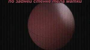 Фиброзно-железистый полип на основании в матке.