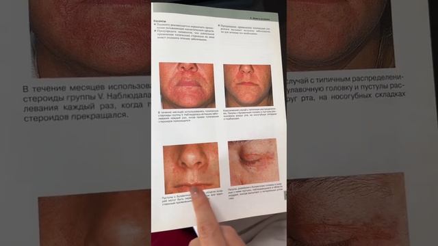 ПЕРИОРАЛЬНЫЙ ДЕРМАТИТ И РОЗАЦЕА - ОДНО И ТОЖЕ? смотреть онлайн
