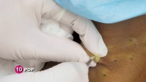 Dr. Lee Pops Over SIXTY Steatocystomas! | Dr. Pimple Popper