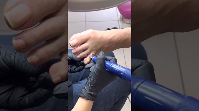 УДАЛЕНИЕ СТЕРЖНЕВОЙ МОЗОЛИ смотреть онлайн