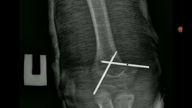 Перелом плечевой кости со смещением. Перелом руки. Лечение. смотреть онлайн