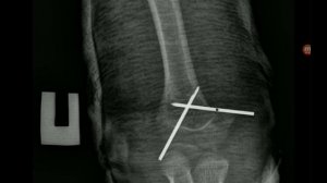 Перелом плечевой кости со смещением. Перелом руки. Лечение.