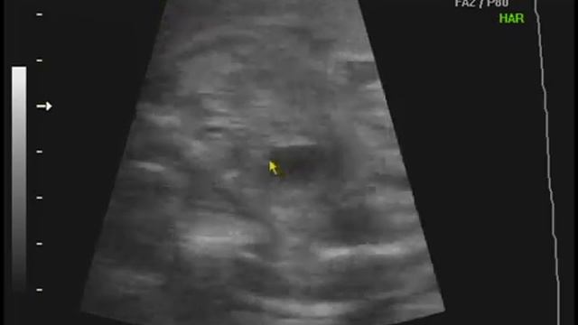 Узи 24 недели - девочка.mp4 смотреть онлайн